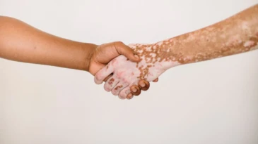 Vitiligo Nedir?