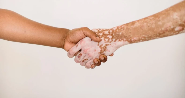 Vitiligo Nedir?