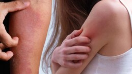 Dermatoloji uzmanı uyardı: Kaşıntı ve kızarıklık varsa…