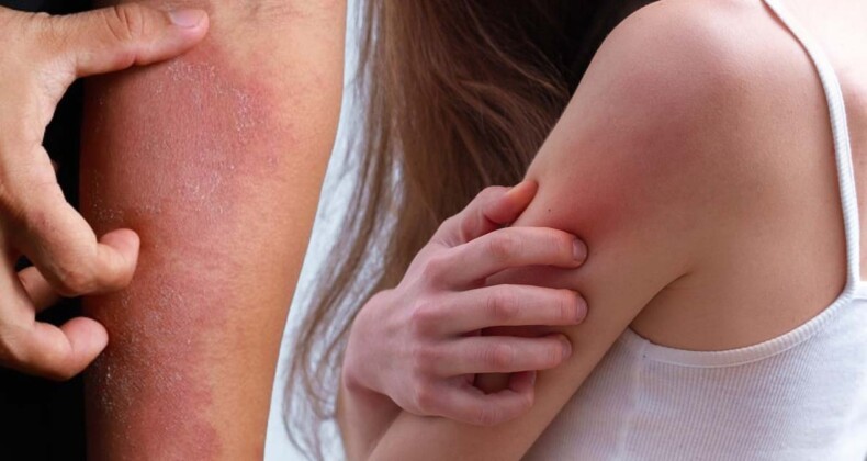 Dermatoloji uzmanı uyardı: Kaşıntı ve kızarıklık varsa…